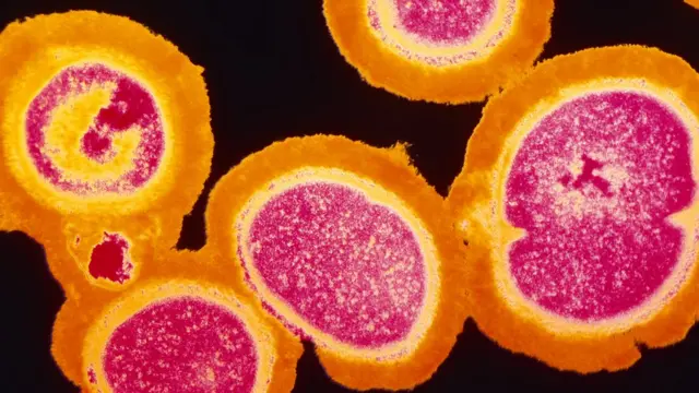 Estafilococo aureus resistente a la meticiclina, SARM (MRSA en inglés)