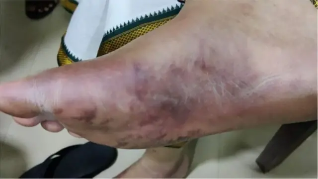 రఘురామకృష్ణరాజు కాళ్లు