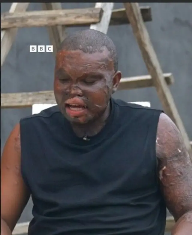 Promise Okwara wọ aṣọ dúdú, ó ń wo ẹ̀gbẹ́, àpá ara jíjónà wà lójú àti apá rẹ̀