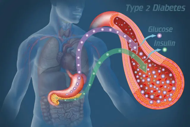 መስርሕ ዓይነት 2 ሕማም ሽኮር ዘርእይ ምስሊ