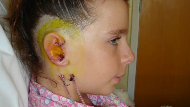 Olivia Howe, de 10 años, en el hospital, vista de perfil mostrando el resultado de la operación para reconstruir su oreja.