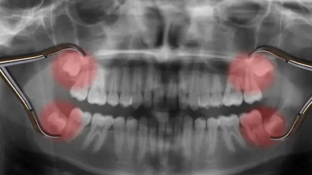 Radiografia mostra os dentes sisos