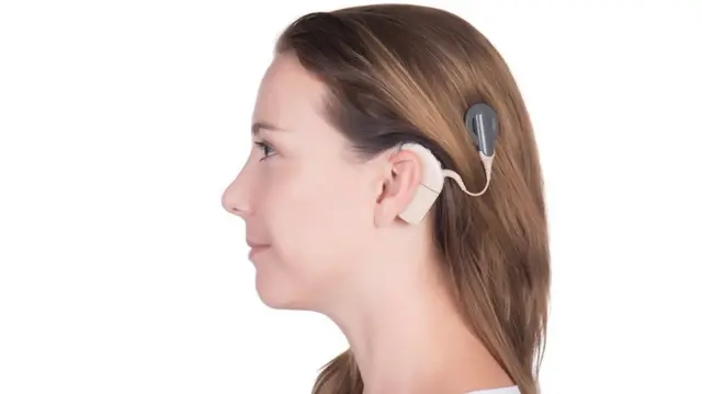 ผู้หญิงที่สวมอุปกรณ์ cochlear