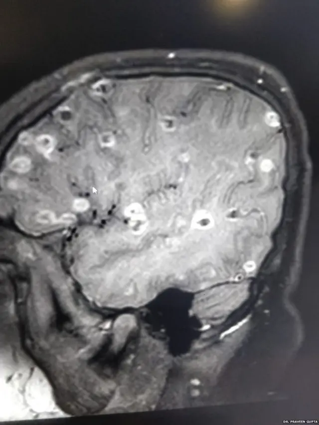 બાળકીના મસ્તકમાં સિટી સ્કેનમાં જોવા મળેલાં કૃમિનાં ઈંડા