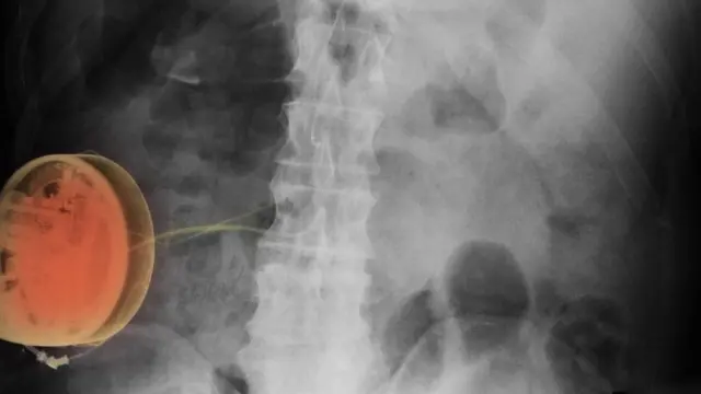 Воздействие на нервные окончания спинного мозга слабым электрическим током при помощи имплантируемого устройства может помочь в облегчении хронической боли