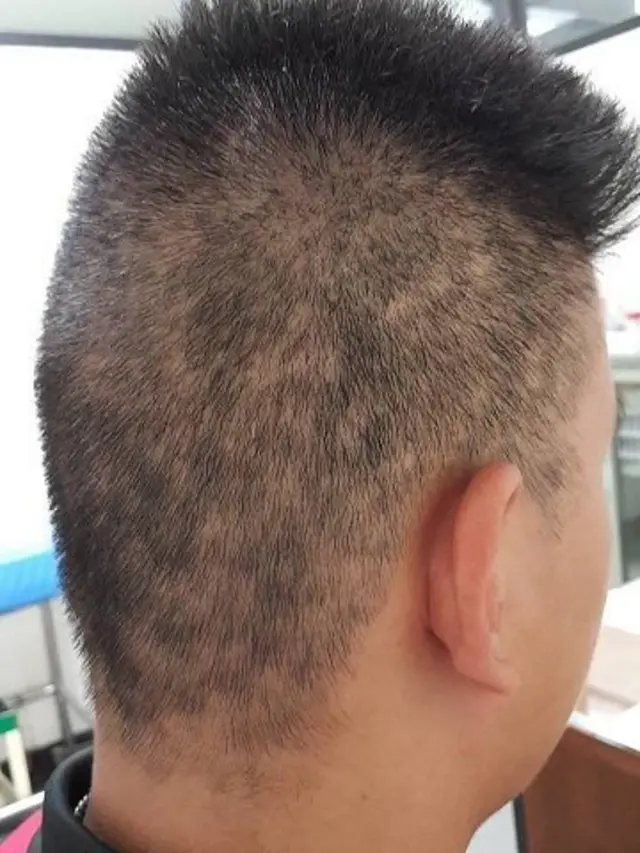 ซิฟิลิส