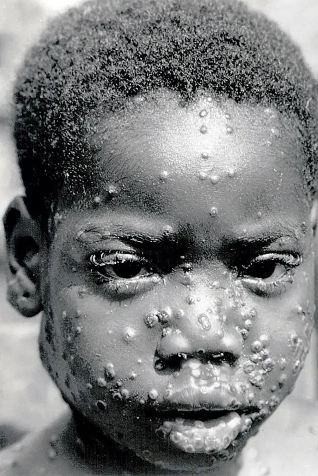 Pickin wey get plenty rash for face wey follow for signs of monkeypox