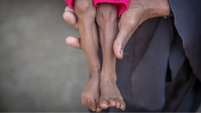 Nusair, 13 months old, in his house in Hodeidah, Yemen. Photo shows his legs.