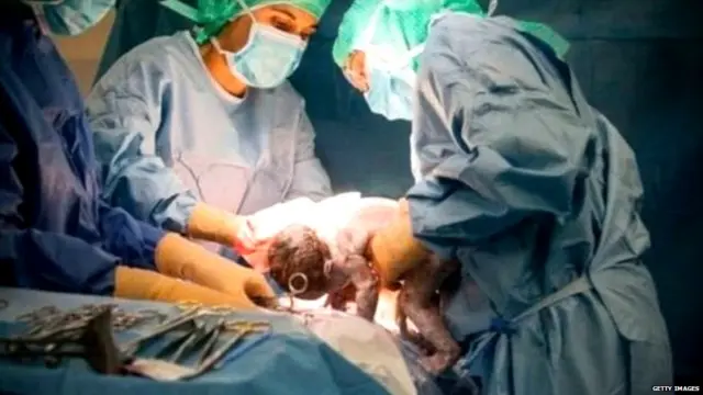 ਬੱਚੇਦਾਨੀ ਦਾ ਟਰਾਂਸਪਲਾਂਟ