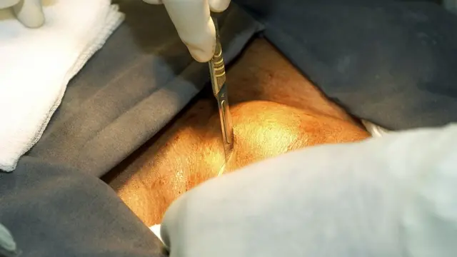 la chirurgie est le recours en cas d'hyperthyroïdie associée à un goitre