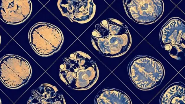 அல்சைமர் நோய்