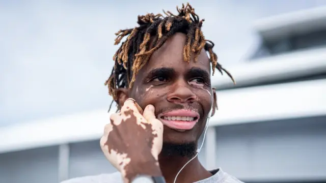 ONwoke nwere Vitiligo