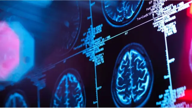 아밀로이드 베타는 뇌의 병원균과 싸우는 일종의 미생물 살충제 역할을 할 수 있다