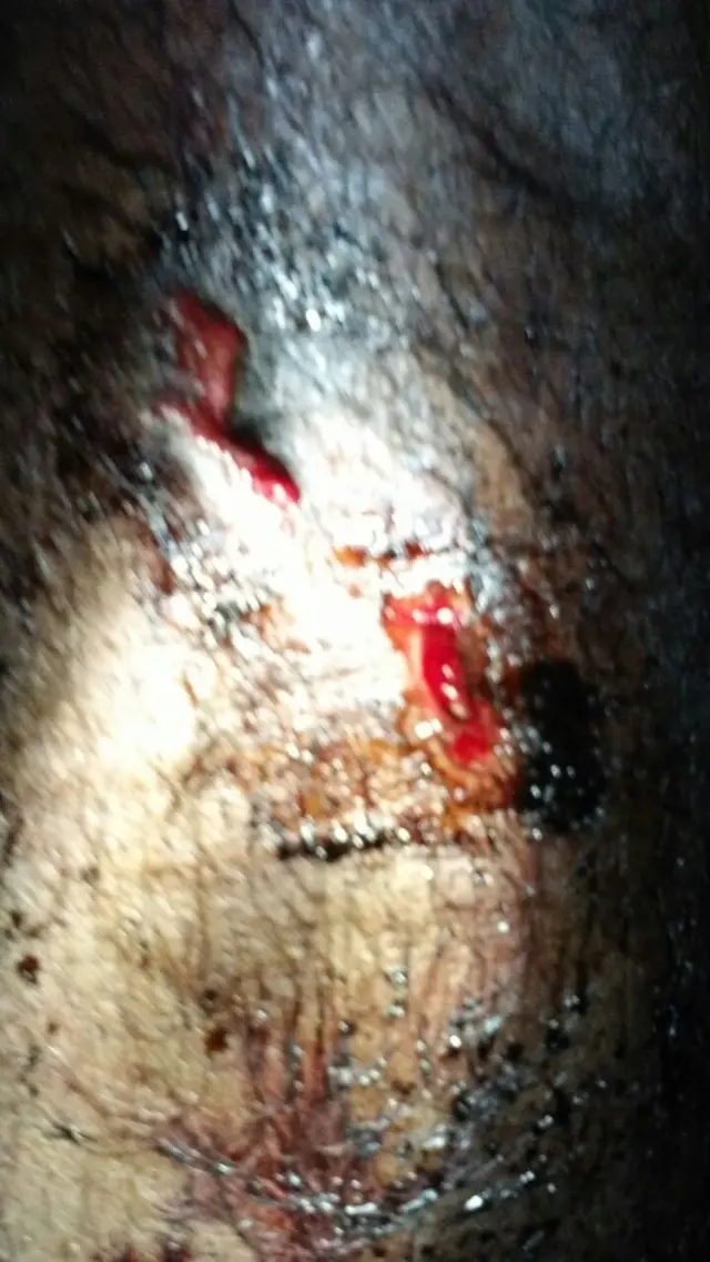 குண்டடிப்பட்டு காயம்