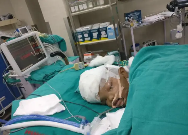 தலை ஒட்டிப் பிறந்த இரட்டையர்கள்: பிரித்த அரசு மருத்துவர்கள்