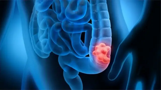 Aworan bi jẹjẹrẹ inu ifun 'colon cancer' ṣe ma n ri