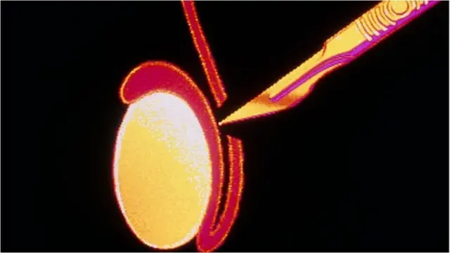 వేసెక్టమీ