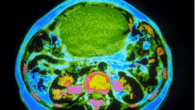 ओवरी कैंसर