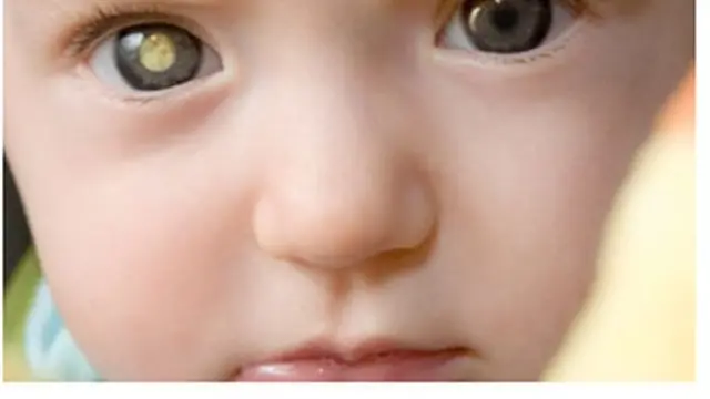 रेटिनोब्लास्टोमा भएको आँखा कस्तो देखिन्छ भन्ने प्रतीकात्मक तस्बिर