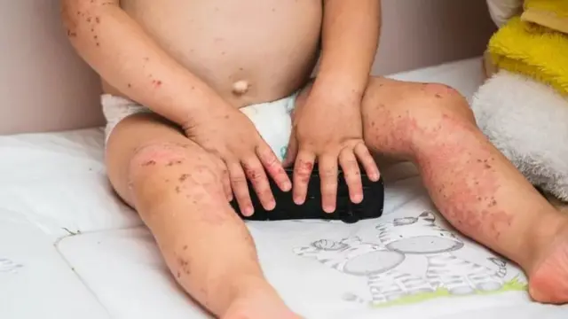 टोमॅटो फ्लू