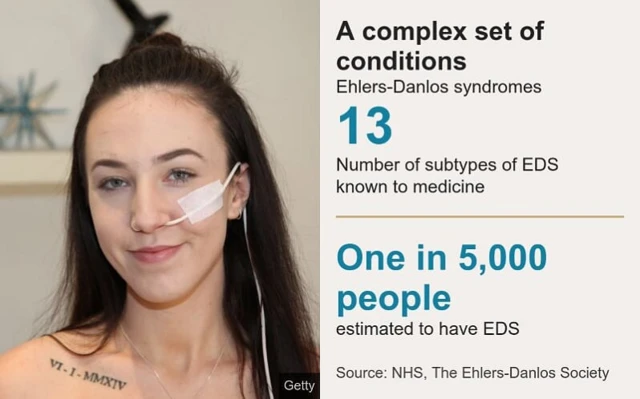 Picture of an Australian girl who has EDS and wears a feeding tube