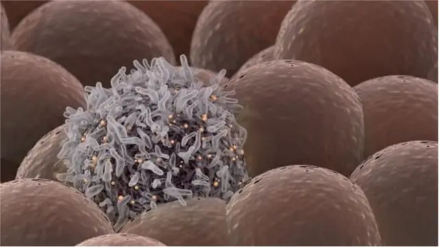 په انګلستان کې میلانوما یا د پوستکي سرطان پنځم عام سرطان دی چې له امله یې هرکال کابو ۲۳۰۰ تنه مري.