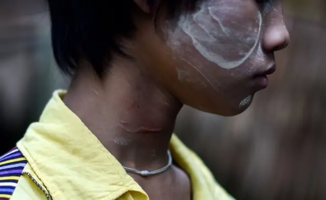 San Kay Khine anaonyesha shingo yake ilojeruhiwa akiwa kwao Baw Lone Kwin, 20 Septemba 2016.