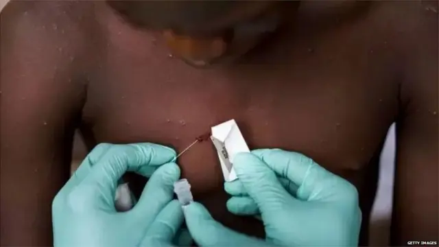 मंकीपॉक्स