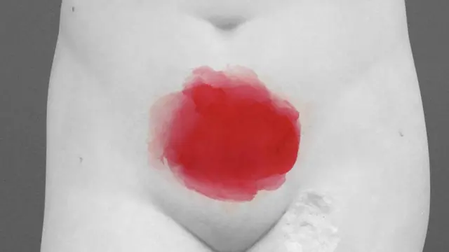 Ендометріоз