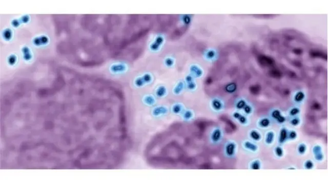 নেইসেরিয়া গনোরিয়া