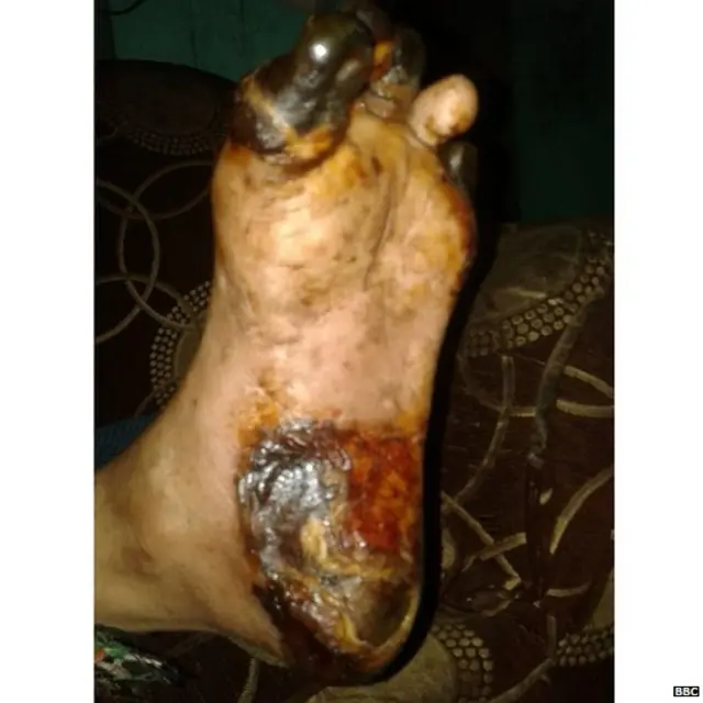 गँगरीन