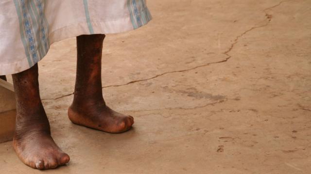 Pernao melhor site de apostas esportivascriança com hanseníase