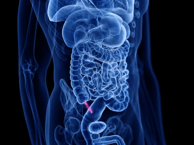 એપેન્ડિસાઈટિસ