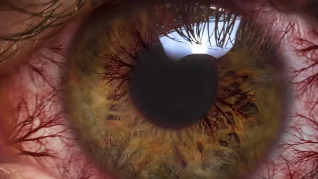 கால நிலை மாற்றம் - குழந்தைகளுக்கு அதிக அளவில் பரவும் 'மெட்ராஸ் - ஐ'