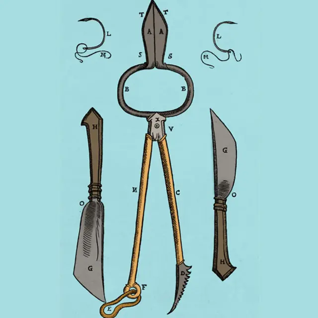 Algunos equipos necesarios para el método de Gaspare Tagliacozzi para hacer crecer una nariz de reemplazo de la piel del brazo. Estos instrumentos especiales se utilizan para esculpir el nuevo tabique nasal.