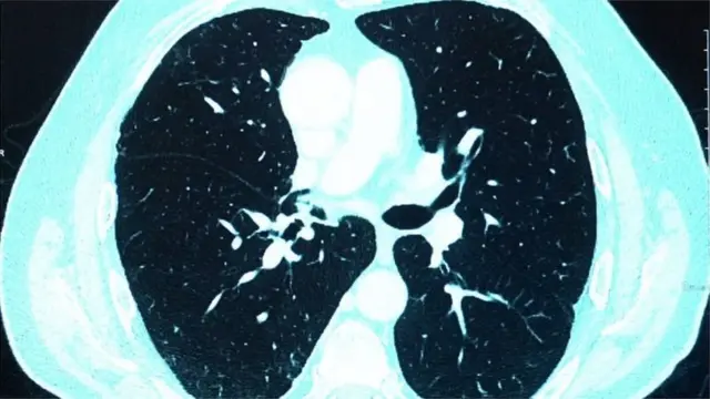 কোভিড আক্রান্ত হবার আগে সুস্থ ফুসফুসের ছবি