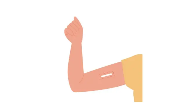 জন্মনিয়ন্ত্রণ ইমপ্ল্যান্ট।