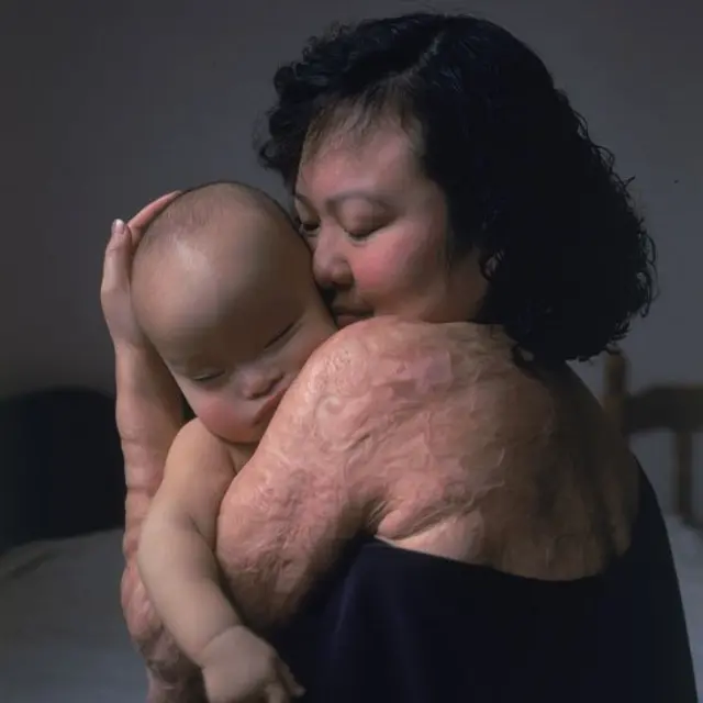 Kim Phuc postrando la piel quemada en su espalda mientras tiene en los brazos a su hijo bebé