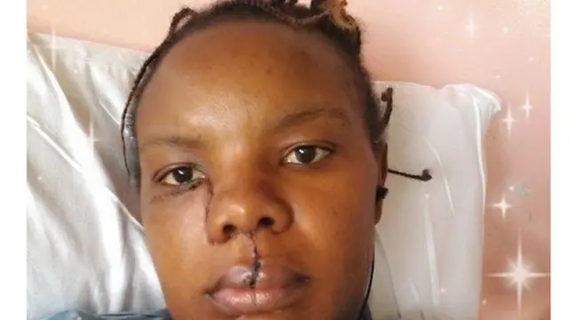 Teresia Njeri alipofanyiwa upasuaji