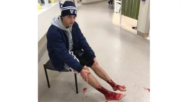 豪の16歳、海に足をつけたら血だらけに 出血止まらず - BBCニュース