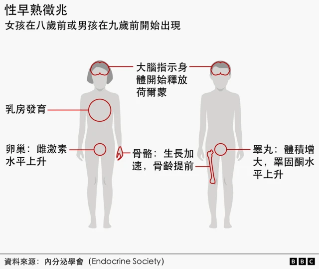 一张男女身体的插图标示了儿童性早熟的征兆。