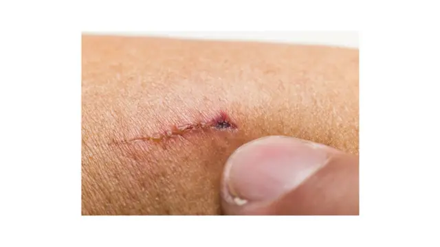 Machucado cicatrizado