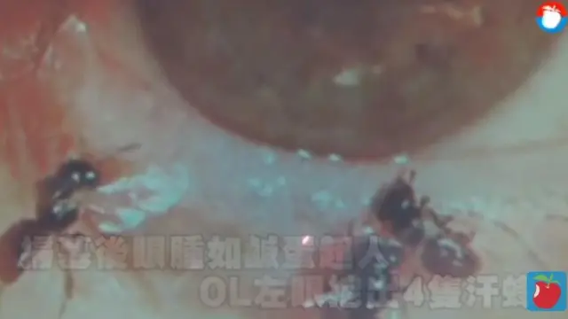 তাইওয়ানের টিভিতে দেখানো হয় চোখের ভেতরে থাকা জীবন্ত মৌমাছির ভিডিও