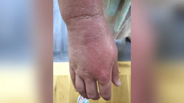 Mãos de Anna com eczema