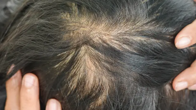 Mujer con inicio de calvicie.