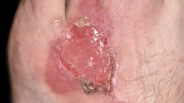 Quemadura en un pie (Foto: Science Photo Library)