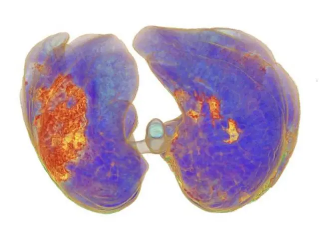 கோவிட் 19 தொற்று உள்ள நுரையீரலின் சி.டி ஸ்கேன் படம்.