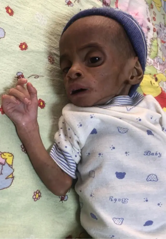 Foto of malnurished six month old Chidubem