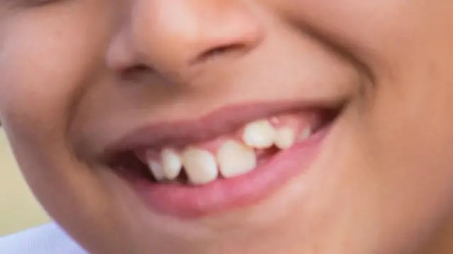 દોઢીયો દાંત 