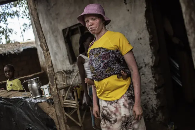 An albino woman in her house